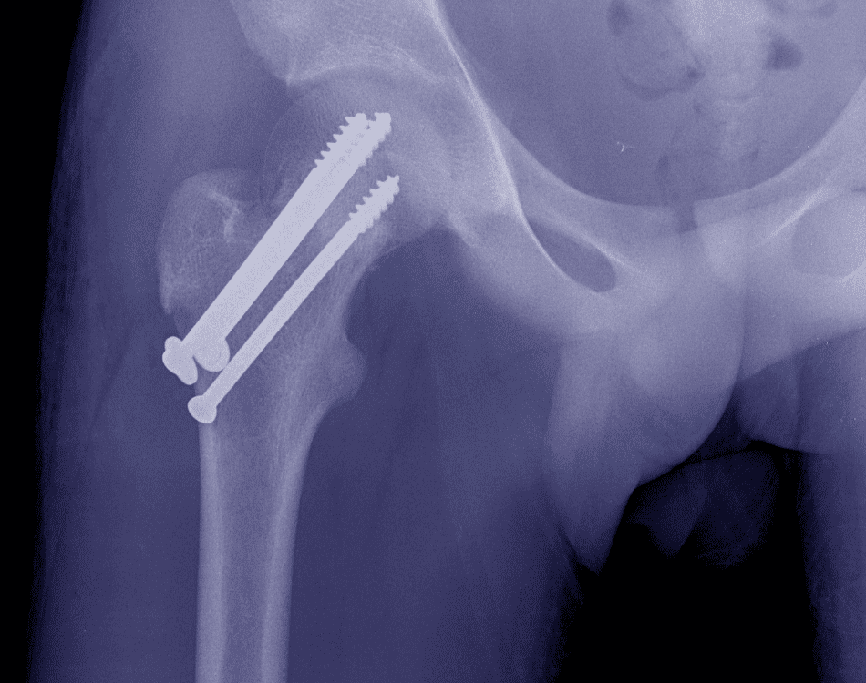 Fijación de fracturas de cadera