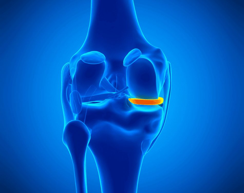 Lesiones de menisco