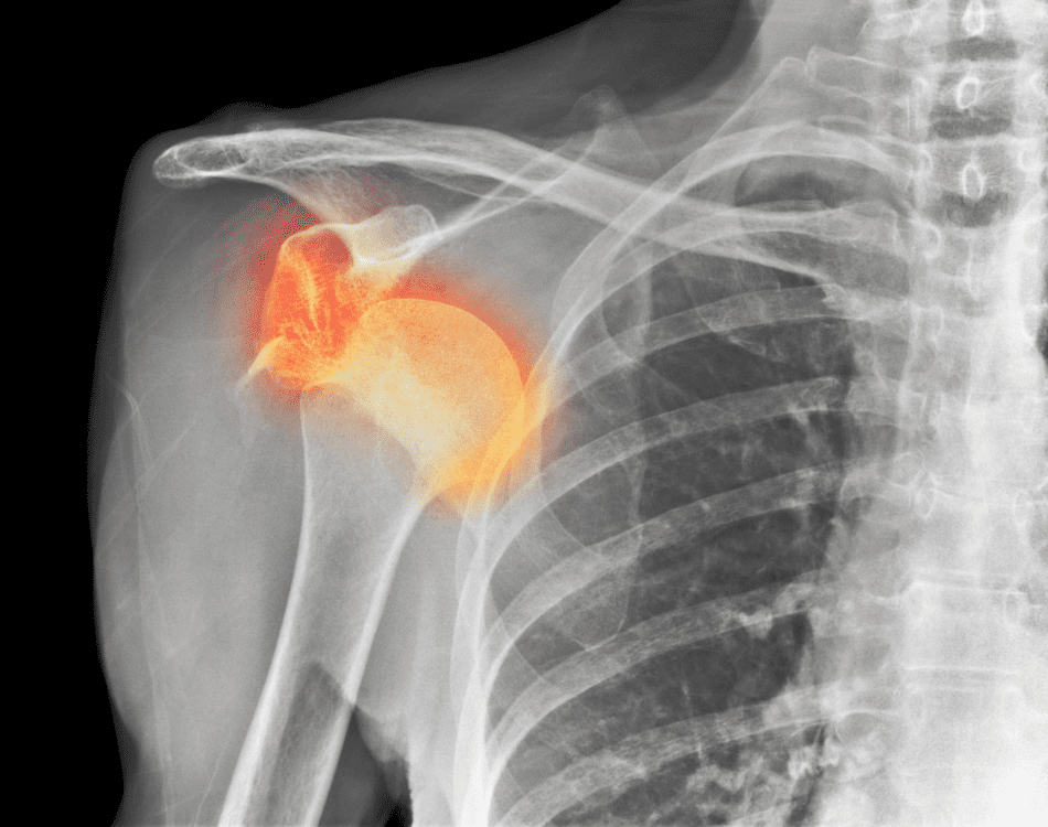 Luxación de prótesis